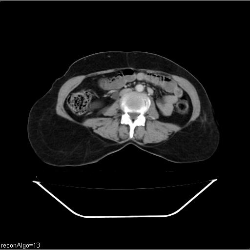 Carcinoma cervix- recurrence (Radiopaedia 34702-36137 B 30).jpg