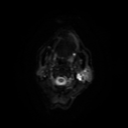 Carcinoma ex-pleomorphic adenoma of parotid (Radiopaedia 28383-28627 Ax DWI B-500 GE 14).jpg