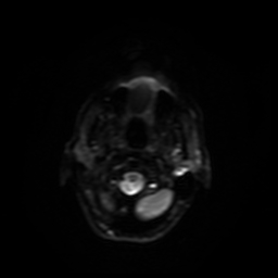 Carcinoma ex-pleomorphic adenoma of parotid (Radiopaedia 28383-28627 Ax DWI B-500 GE 19).jpg
