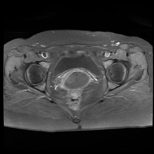 File:Carcinoma of the cervix (Radiopaedia 89018-105858 Axial T1 C+ fat sat 12).jpg
