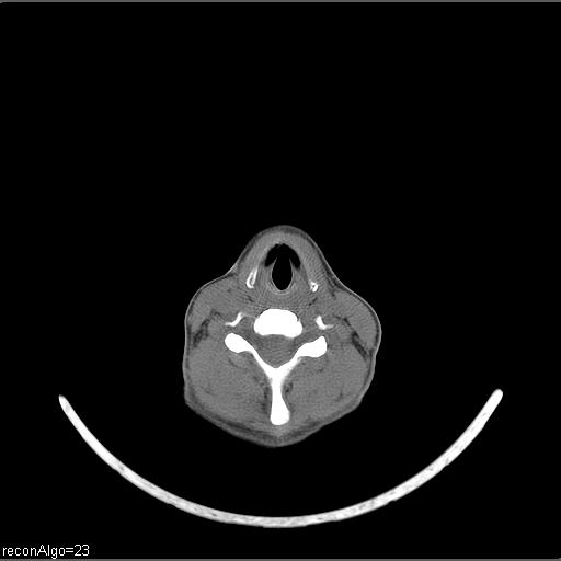 Carcinoma of the maxillary antrum (Radiopaedia 53805-59888 Axial non-contrast 26).jpg