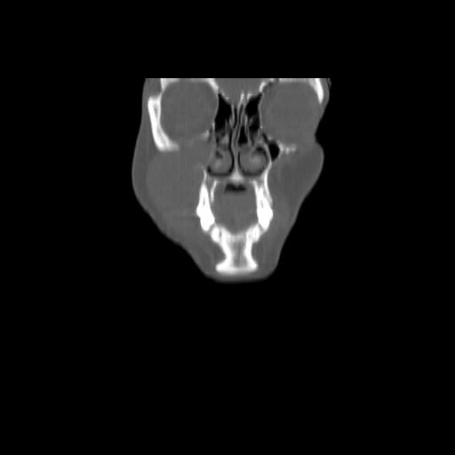 Carcinoma of the maxillary antrum (Radiopaedia 53805-59888 Coronal bone window 26).jpg