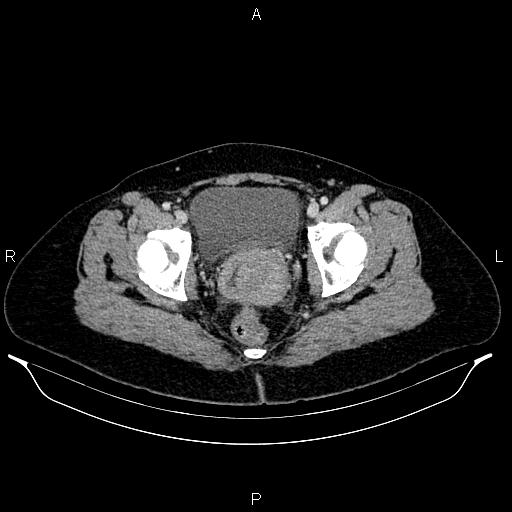 File:Carcinoma of uterine cervix (Radiopaedia 85861-101700 A 72).jpg
