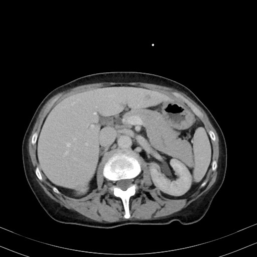 Carcinosarcoma (Radiopaedia 70401-80503 A 21).jpg