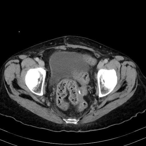 Carcinosarcoma (Radiopaedia 70401-80503 A 60).jpg