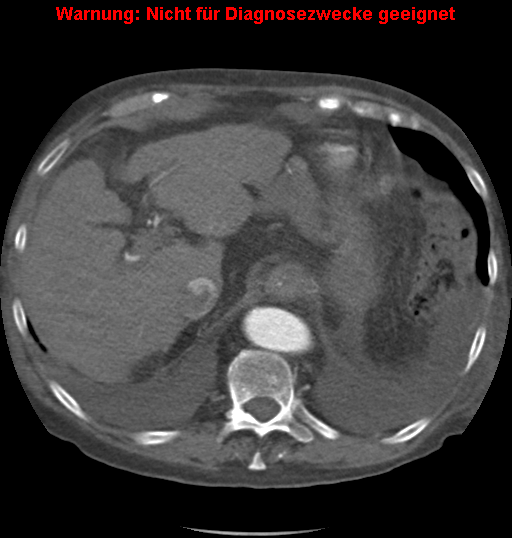 File:Cardiac perforation following transcatheter aortic valve implantation (Radiopaedia 23714-23863 A 19).png