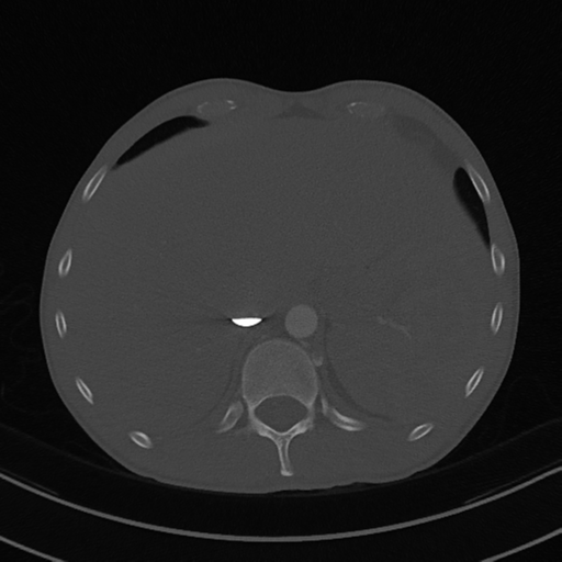 Cardiac tumor - undifferentiated pleomorphic sarcoma (Radiopaedia 45844-50134 Axial bone window 64).png