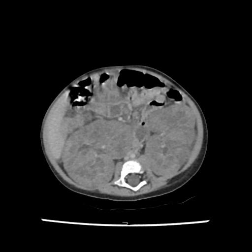 Caroli disease with autosomal recessive polycystic kidney disease (ARPKD) (Radiopaedia 89651-106703 B 126).jpg