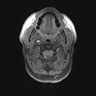 File:Carotid artery dissection (Radiopaedia 28441-28689 Axial T1 fat sat 29).jpg
