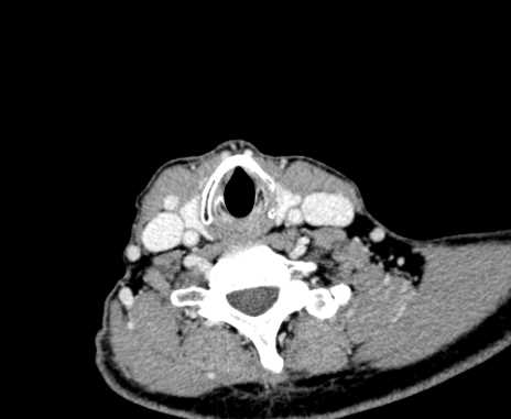 Carotid body tumor (Radiopaedia 61750-69757 Axial Post contrast 87).jpg
