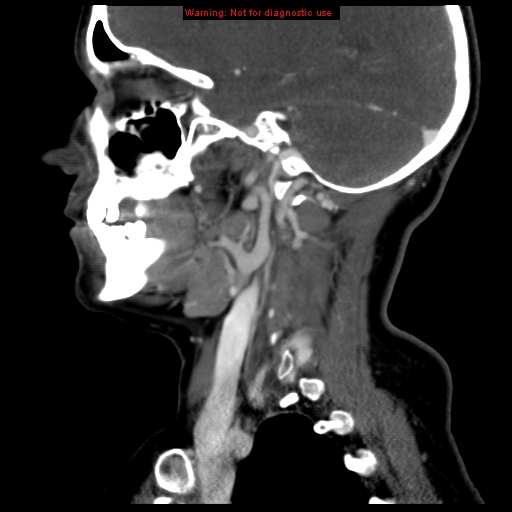 Carotid body tumor with lung metastases (Radiopaedia 9301-9986 Sagittal C+ delayed 17).jpg