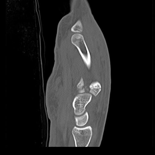 File:Carpo-metacarpal fracture-dislocations with hamatum split fracture (Radiopaedia 18482-18343 Sagittal bone window 15).jpg