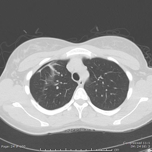 Catamenial pneumothorax (Radiopaedia 54382-60600 Axial non-contrast 24).jpg