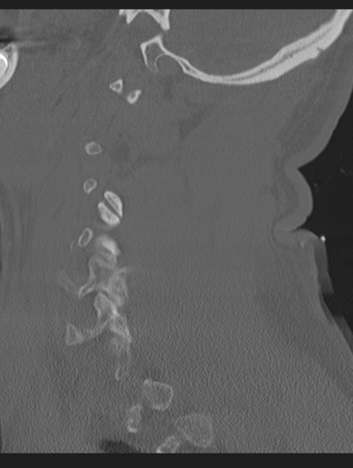 Cavernoma of cervical cord (Radiopaedia 50838-56346 Sagittal bone window 61).png