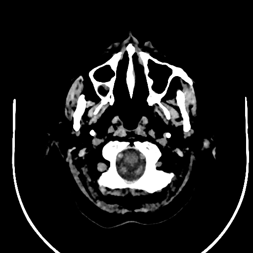 Cavernous hemangioma of the cerebellar falx (Radiopaedia 73025-83723 Axial non-contrast 6).jpg