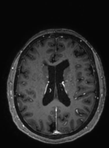 Cavernous hemangioma of the cerebellar falx (Radiopaedia 73025-83724 Axial T1 C+ 134).jpg
