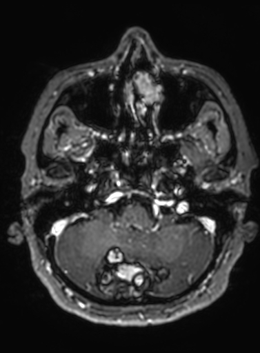 Cavernous hemangioma of the cerebellar falx (Radiopaedia 73025-83724 Axial T1 C+ 271).jpg