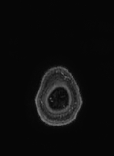 Cavernous hemangioma of the cerebellar falx (Radiopaedia 73025-83724 Axial T1 C+ 6).jpg