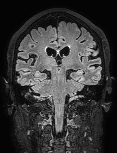Cavernous hemangioma of the cerebellar falx (Radiopaedia 73025-83724 Coronal FLAIR 207).jpg