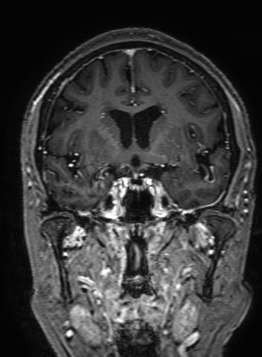 Cavernous hemangioma of the cerebellar falx (Radiopaedia 73025-83724 Coronal T1 C+ 158).jpg