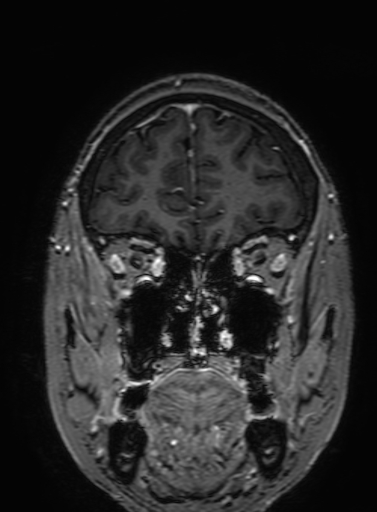 Cavernous hemangioma of the cerebellar falx (Radiopaedia 73025-83724 Coronal T1 C+ 82).jpg