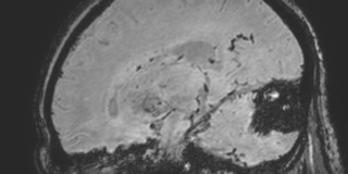 File:Cavernous hemangioma of the cerebellar falx (Radiopaedia 73025-83724 Sagittal BOLD 75).jpg