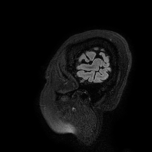 Cavernous hemangioma of the cerebellar falx (Radiopaedia 73025-83724 Sagittal FLAIR 210).jpg