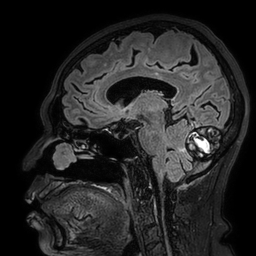 Cavernous hemangioma of the cerebellar falx (Radiopaedia 73025-83724 Sagittal FLAIR 94).jpg