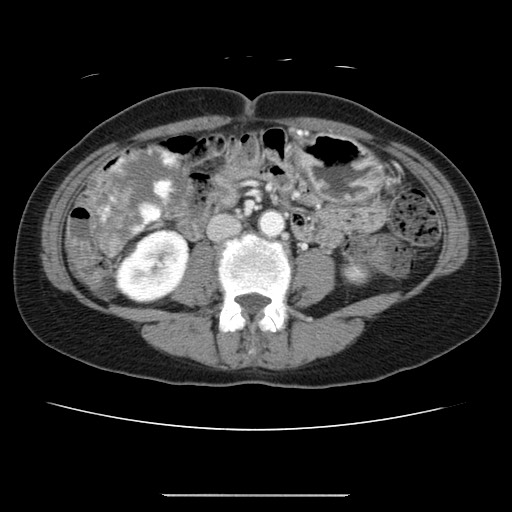 Cavernous hepatic hemangioma (Radiopaedia 75441-86667 B 62).jpg