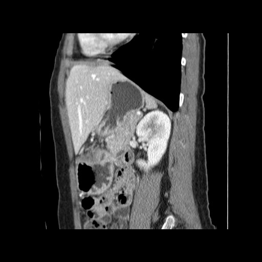 Cavernous hepatic hemangioma (Radiopaedia 75441-86667 D 134).jpg