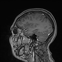 Cavernous sinus meningioma (Radiopaedia 63682-72367 Sagittal T1 C+ 124).jpg