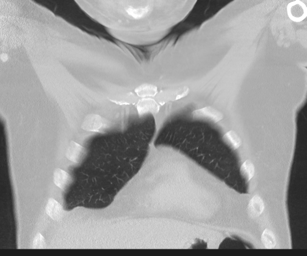 File:Cavitating pneumonia (Radiopaedia 45998-50329 Coronal lung window 10).png