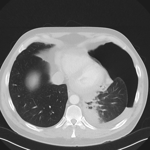 Cavitating pneumonia complicated by pneumothorax (Radiopaedia 48149-52994 Axial lung window 50).png