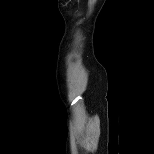 Cecal adenocarcinoma (Radiopaedia 75909-87331 C 10).jpg