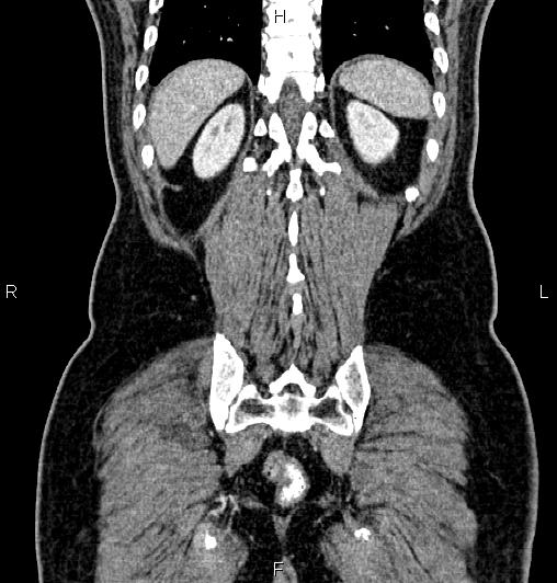 Cecal adenocarcinoma (Radiopaedia 85324-100916 D 57).jpg