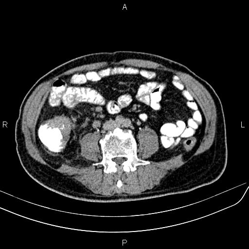 File:Cecal cancer with appendiceal mucocele (Radiopaedia 91080-108651 Axial C+ delayed 42).jpg