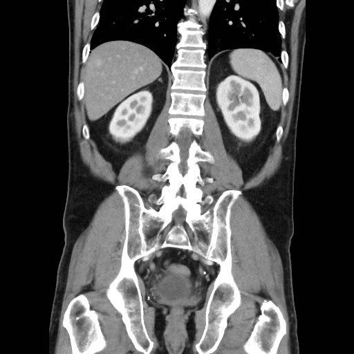 Cecal mass causing appendicitis (Radiopaedia 59207-66531 B 38).jpg