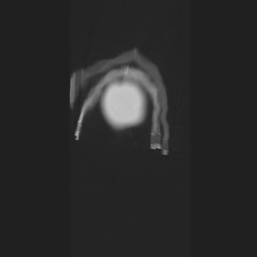 Cecal volvulus (Radiopaedia 75378-86620 Coronal lung window 4).jpg