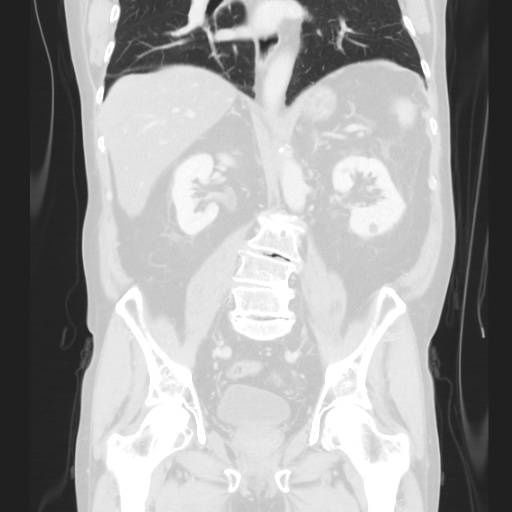 Cecal volvulus (Radiopaedia 75378-86620 Coronal lung window 87).jpg