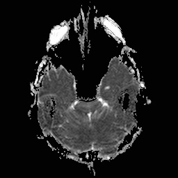 File:Central-variant posterior reversible encephalopathy syndrome (PRES) (Radiopaedia 43880-47358 Axial ADC 6).jpg