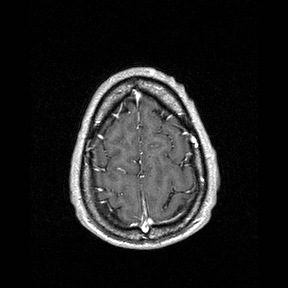 Central-variant posterior reversible encephalopathy syndrome (PRES) (Radiopaedia 43880-47358 Axial T1 C+ 150).jpg
