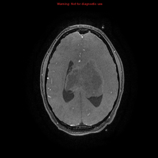 Central neurocytoma (Radiopaedia 13188-13206 Axial MRA 4).jpg
