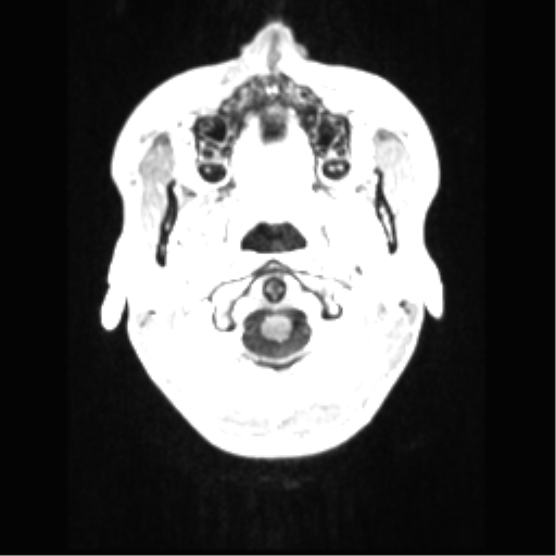 File:Central neurocytoma (Radiopaedia 37664-39557 Axial T1 C+ 5).png