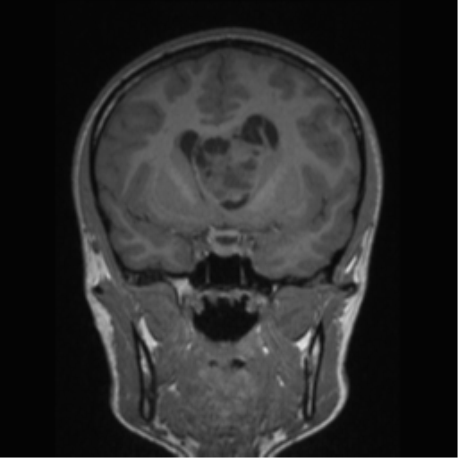 Central neurocytoma (Radiopaedia 37664-39557 Coronal T1 55).png