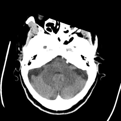 Central neurocytoma (Radiopaedia 65317-74346 Axial C+ delayed 12).png