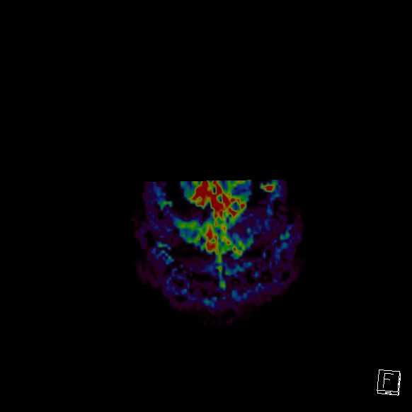 Central neurocytoma (Radiopaedia 84497-99872 Axial Perfusion 7).jpg