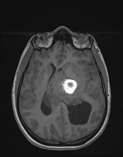 File:Central neurocytoma (Radiopaedia 84497-99872 Axial T1 111).jpg