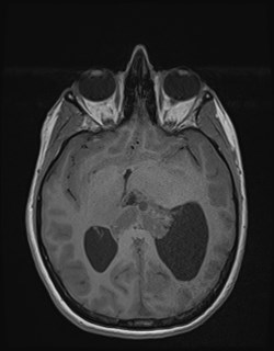 File:Central neurocytoma (Radiopaedia 84497-99872 Axial T1 96).jpg