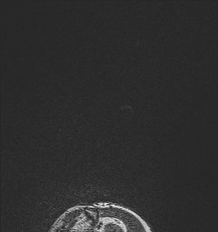 File:Central neurocytoma (Radiopaedia 84497-99872 Sagittal Flair + Gd 4).jpg