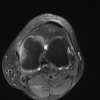 File:Central osteophyte (Radiopaedia 72592-83151 Axial PD fat sat 19).jpg